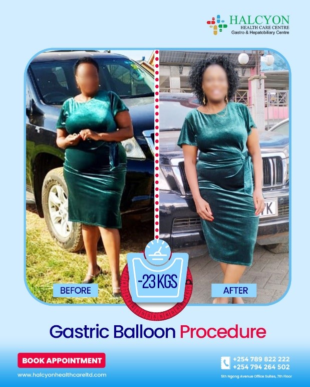 Weight Loss Journey With Endoscopic Gastric Balloon: <strong style="color:#0c0b42;">Patient Review</strong>